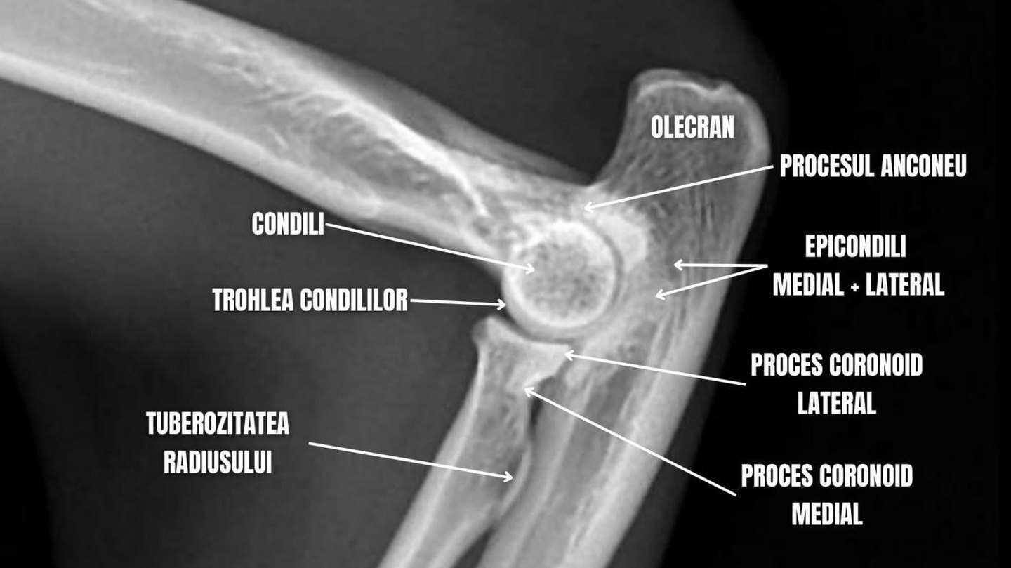 Radiografie mediolaterală a articulației humero-radio-ulnare, caz din arhivă