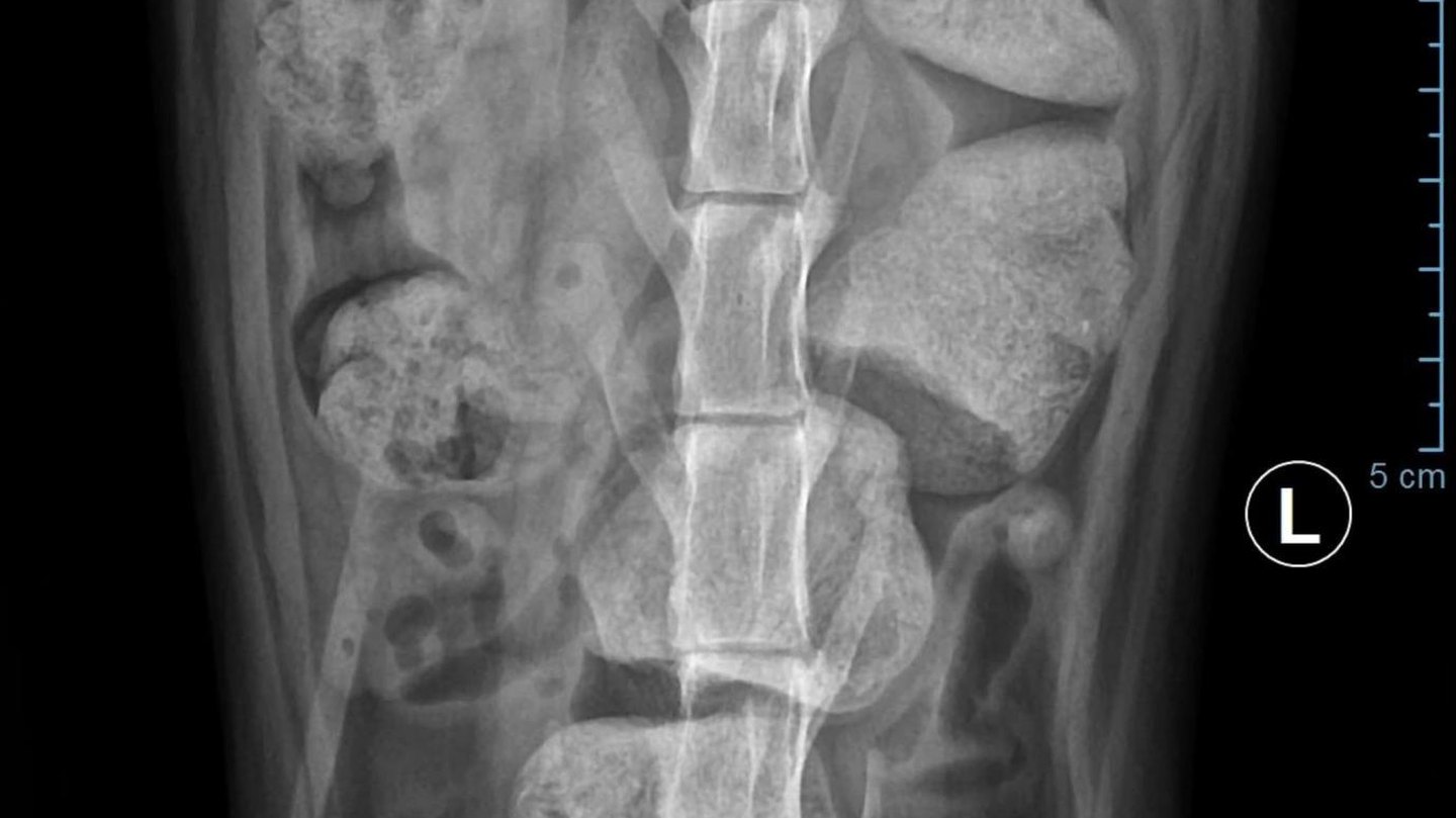 Radiografie abdominală cu un corp străin metalic, caz din arhivă