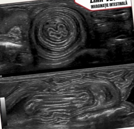 Imagine ecografică a unei invaginații intestinale, caz din arhivă