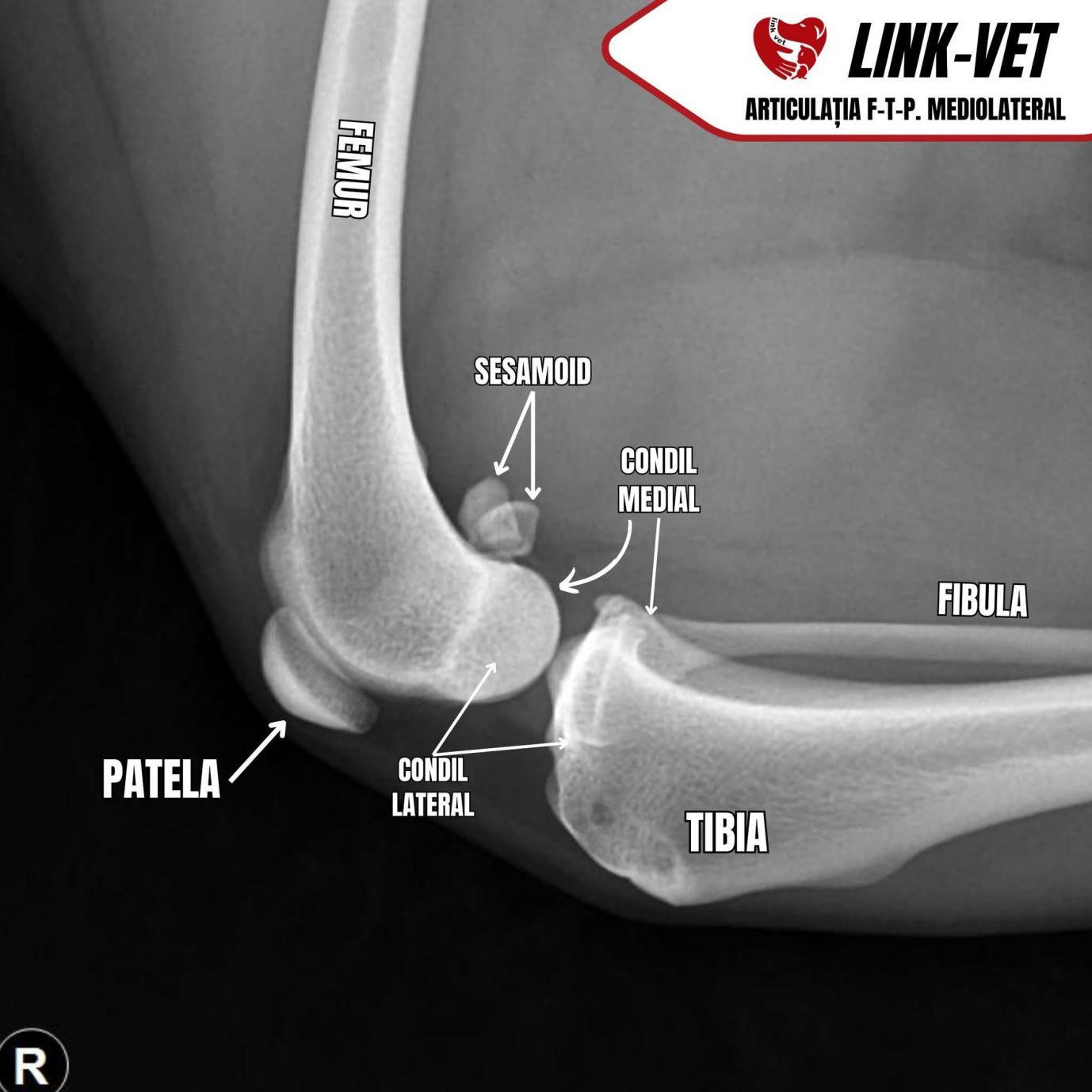 Radiografie mediolaterală a articulației femuro-tibio-patelare, caz din arhivă